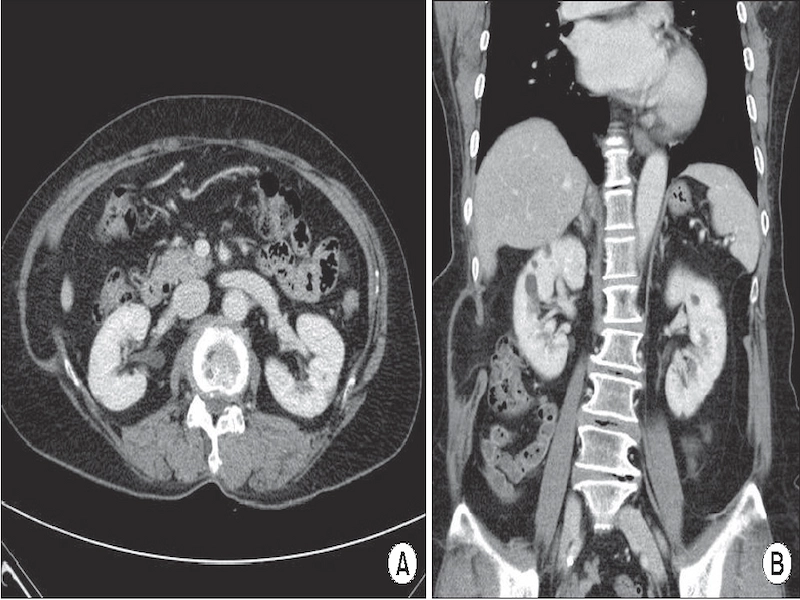 abdominal hernia