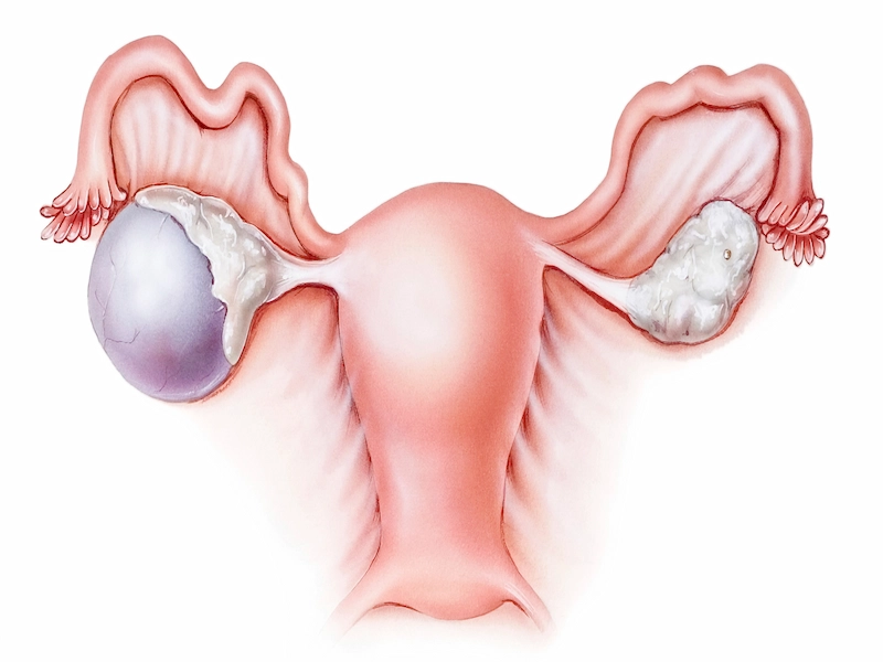 ارتباط چاقی و کیست تخمدان