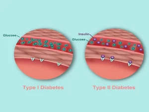 انواع دیابت