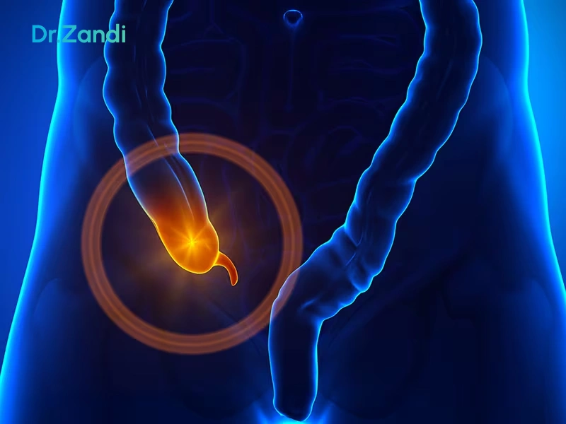 علائم آپاندیس