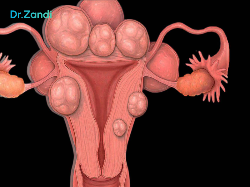 علائم فیبروم رحم