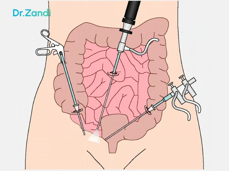 هزینه ی عمل آپاندیس