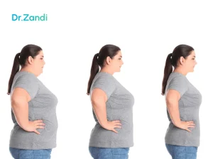 حداقل میزان کاهش وزن بعد از جراحی اسلیو معده چقدر است؟
