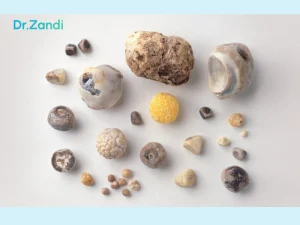 پیامدهای خطرناک درمان نکردن سنگ کیسه صفرا