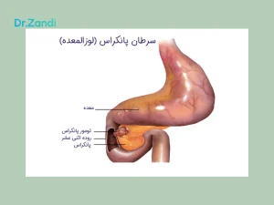 سرطان پانکراس چیست؟