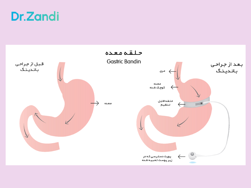 عمل باندینگ معده چیست
