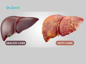 درمان کبد گرید ۳ با عمل لاغری